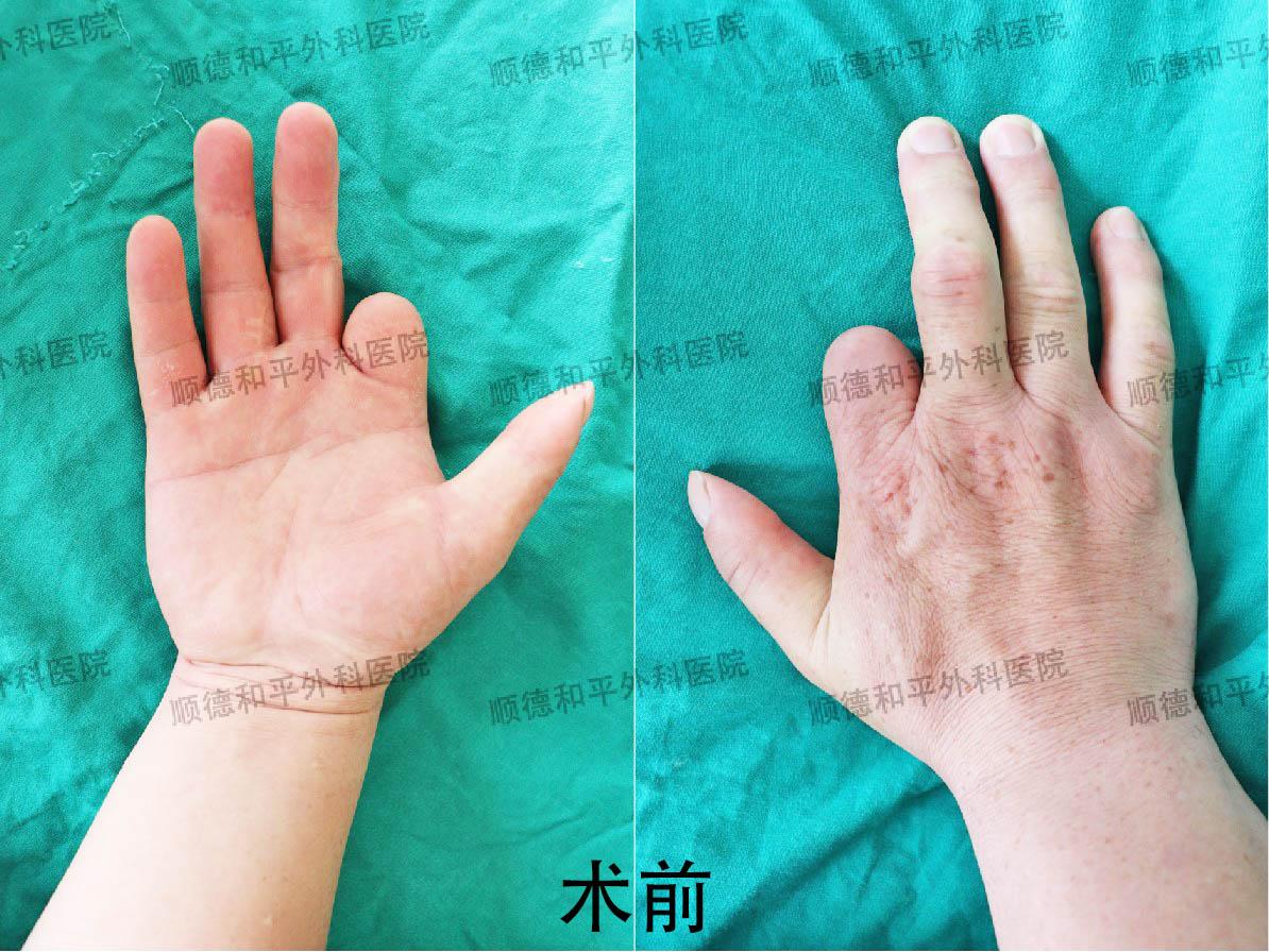 新疆患者失去手指心生自卑，遠赴廣東手指再造＿手外科醫(yī)院咨詢