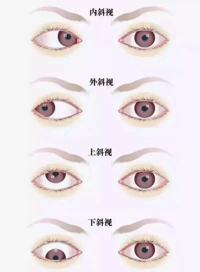 愛爾眼科：總愛偏頭看，視力“一好一壞”？警惕斜視！(圖1)