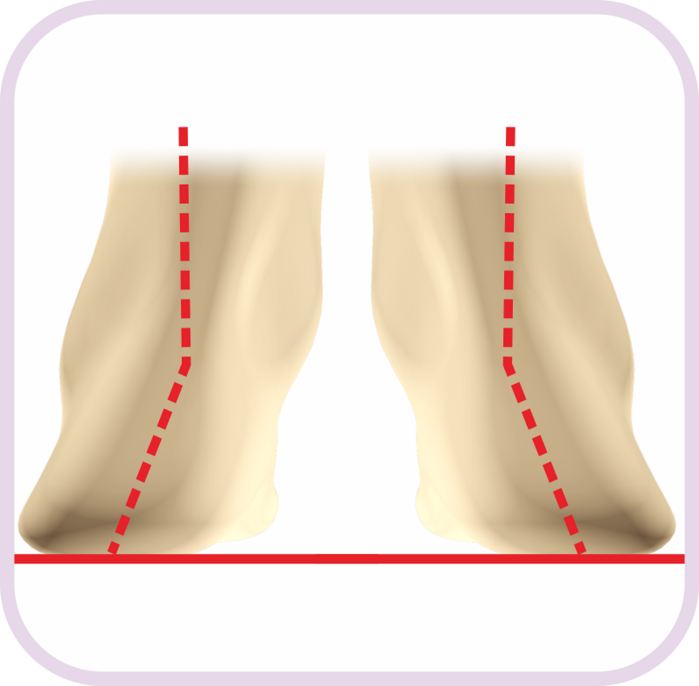 矯正鞋墊和矯正鞋結(jié)合，科學(xué)干預(yù)兒童足外翻