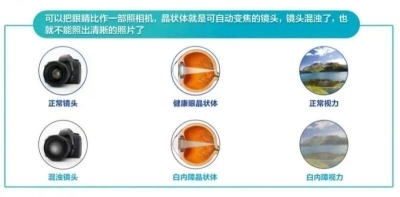 愛爾眼科：白內(nèi)障不會“缺席”只會“遲到”？